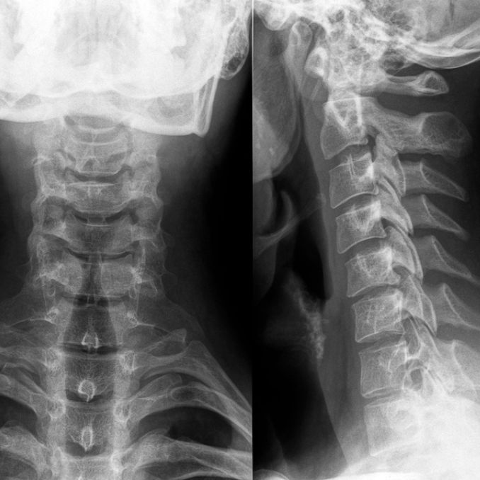 Cervical Spine - Thoracic Mobility
