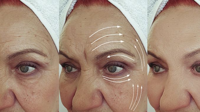 Elderly woman face removal collagen saggy wrinkles